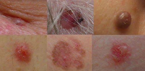 skin cancer symptoms image