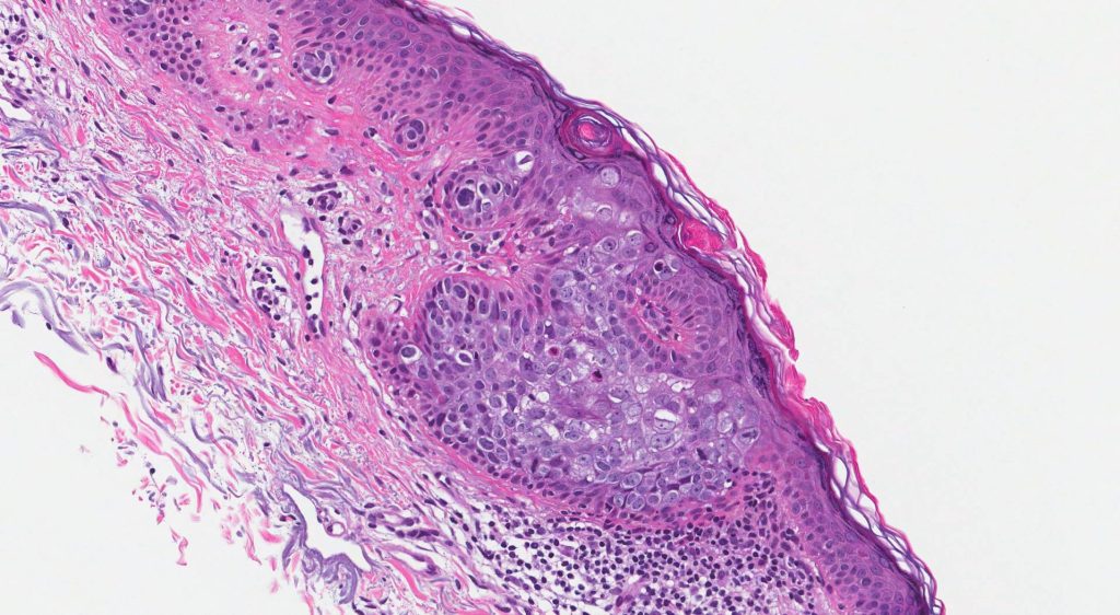 Bowens disease pathology