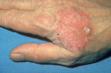 bowens disease on hand