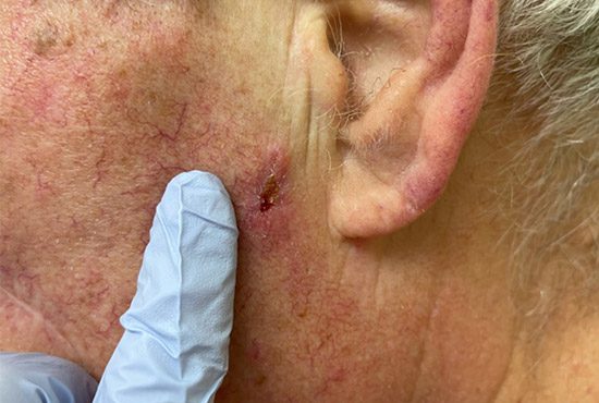 squamous cell carcinoma symptoms