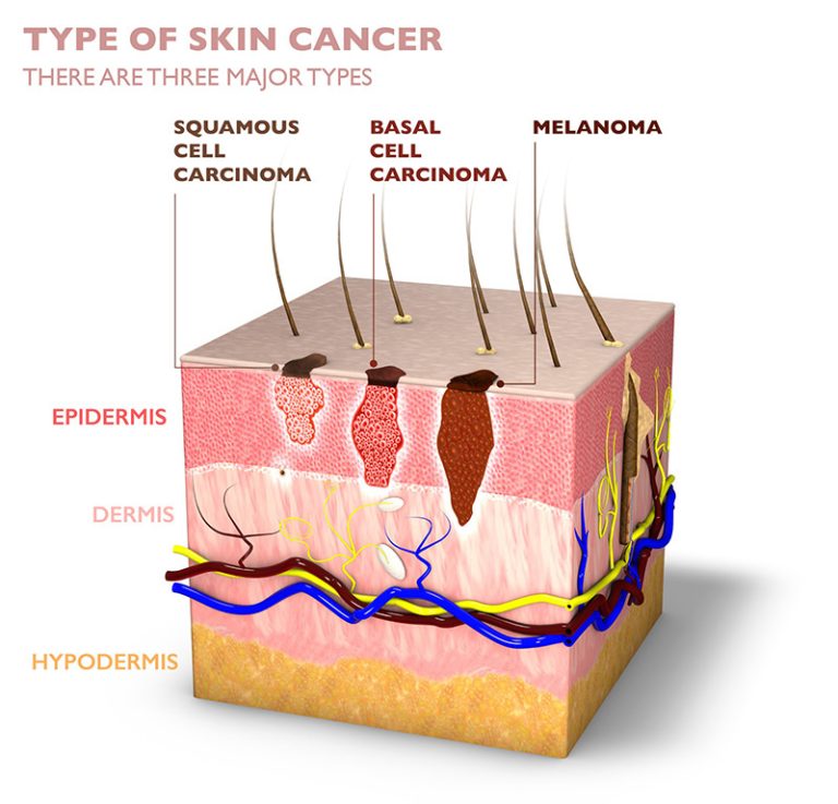 squamous-cell-carcinoma-mobile-skin-solutions