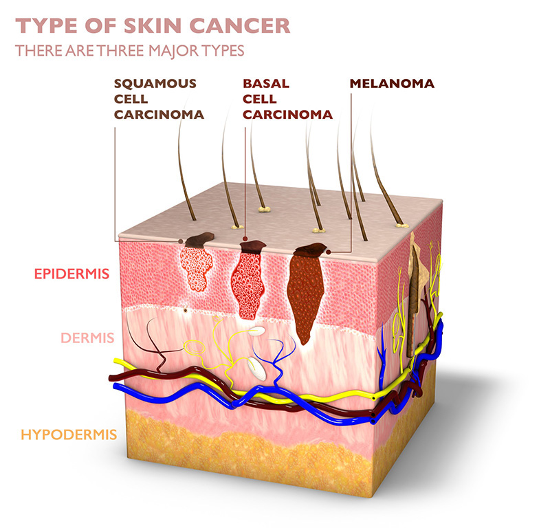 squamous cell skin cancer scc